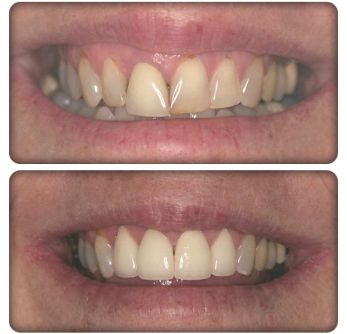 cosmetic dentistry example of before and after
