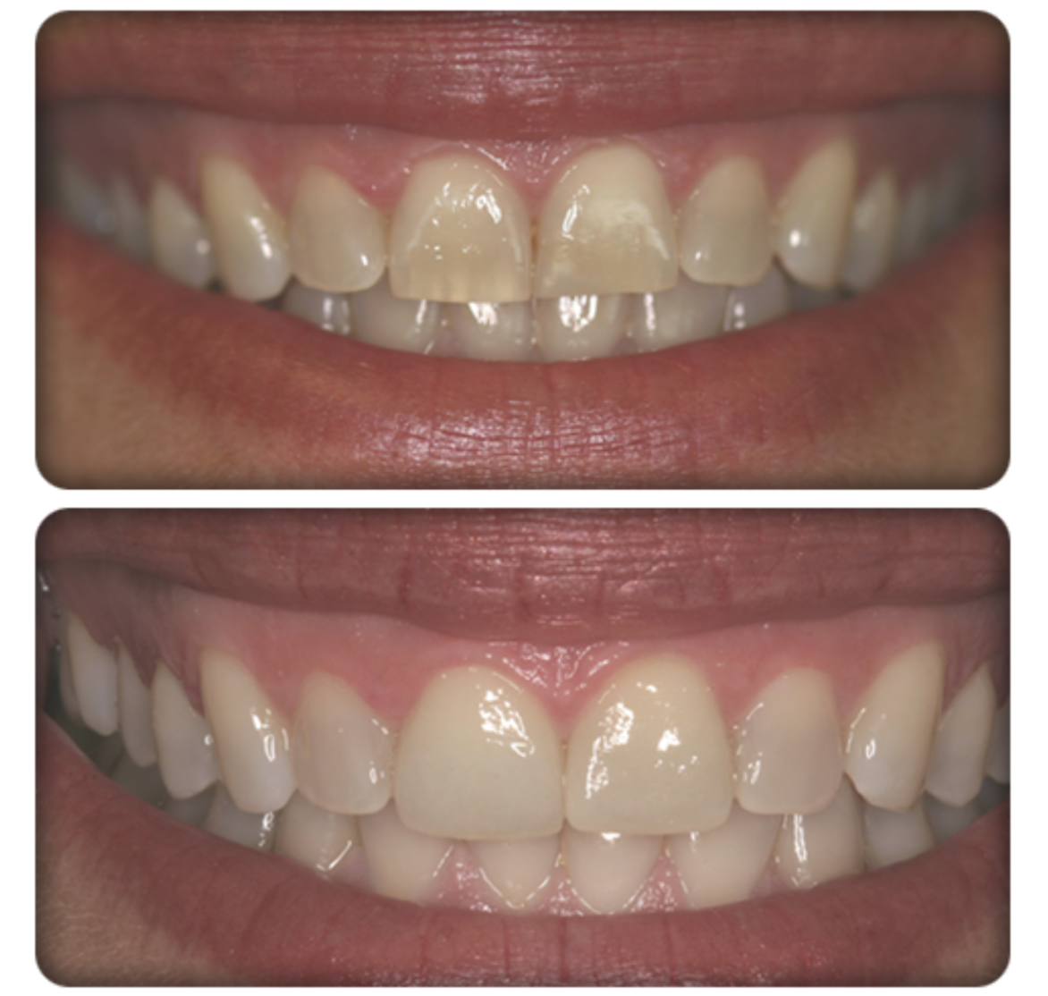 before cosmetic dentistry vs after