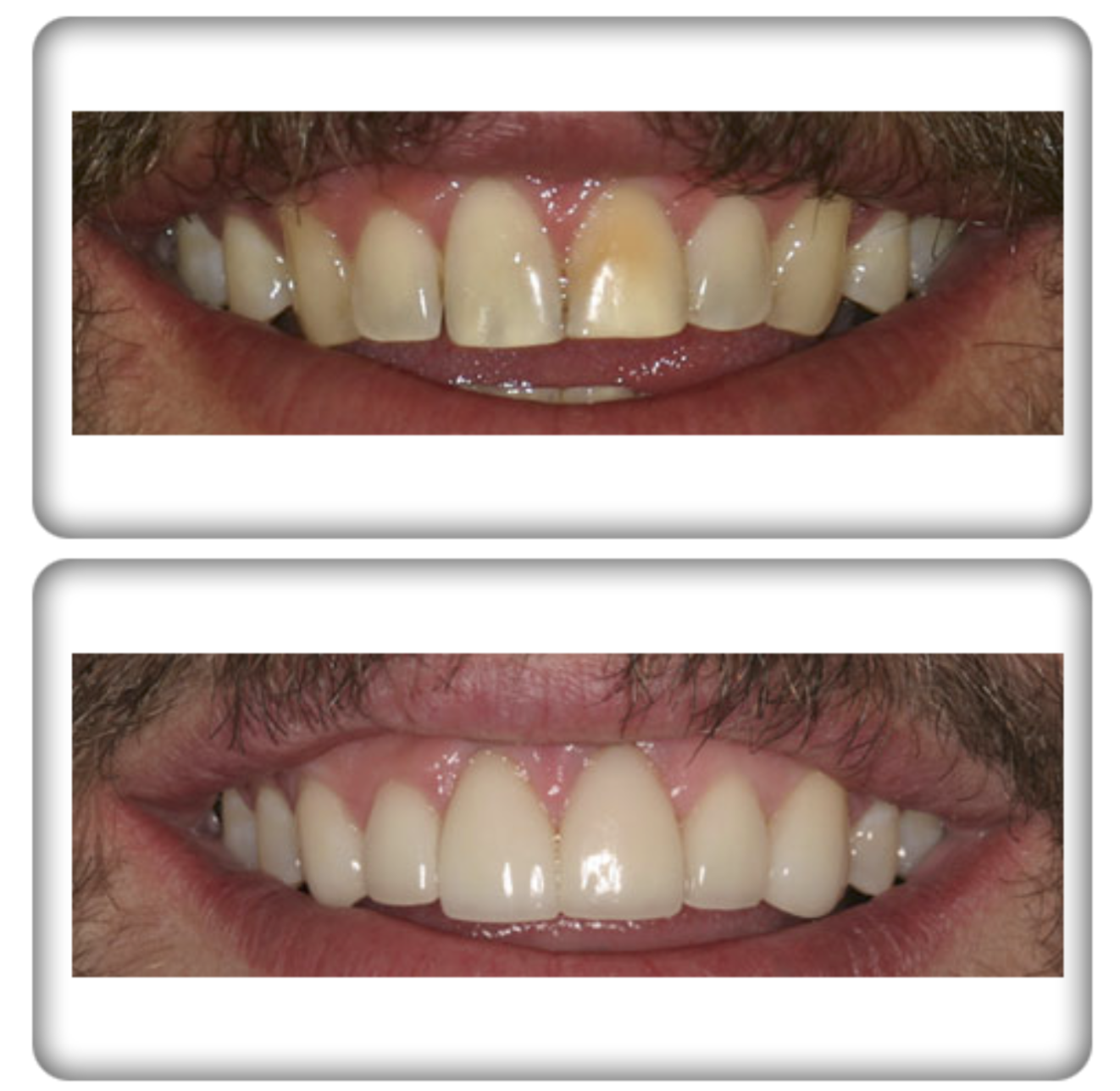 image showing before and after difference from cosmetic dentistry services